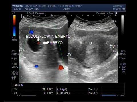 A Pregnancy of 7 weeks, Ultrasound Findings.