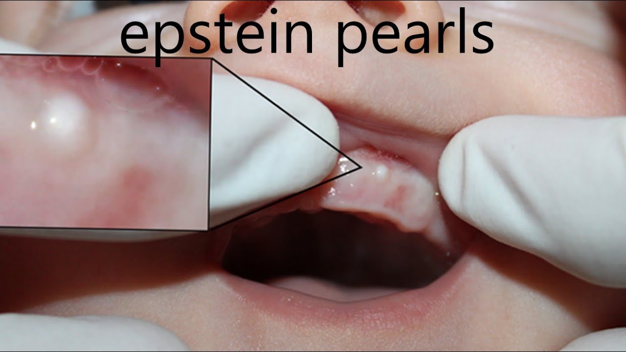 Epstein pearls in infants