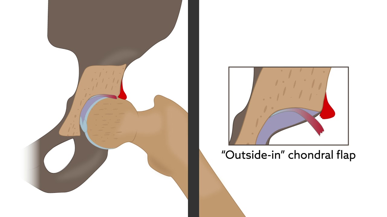 Hip impingement and hip dysplasia have different patterns of cartilage injury
