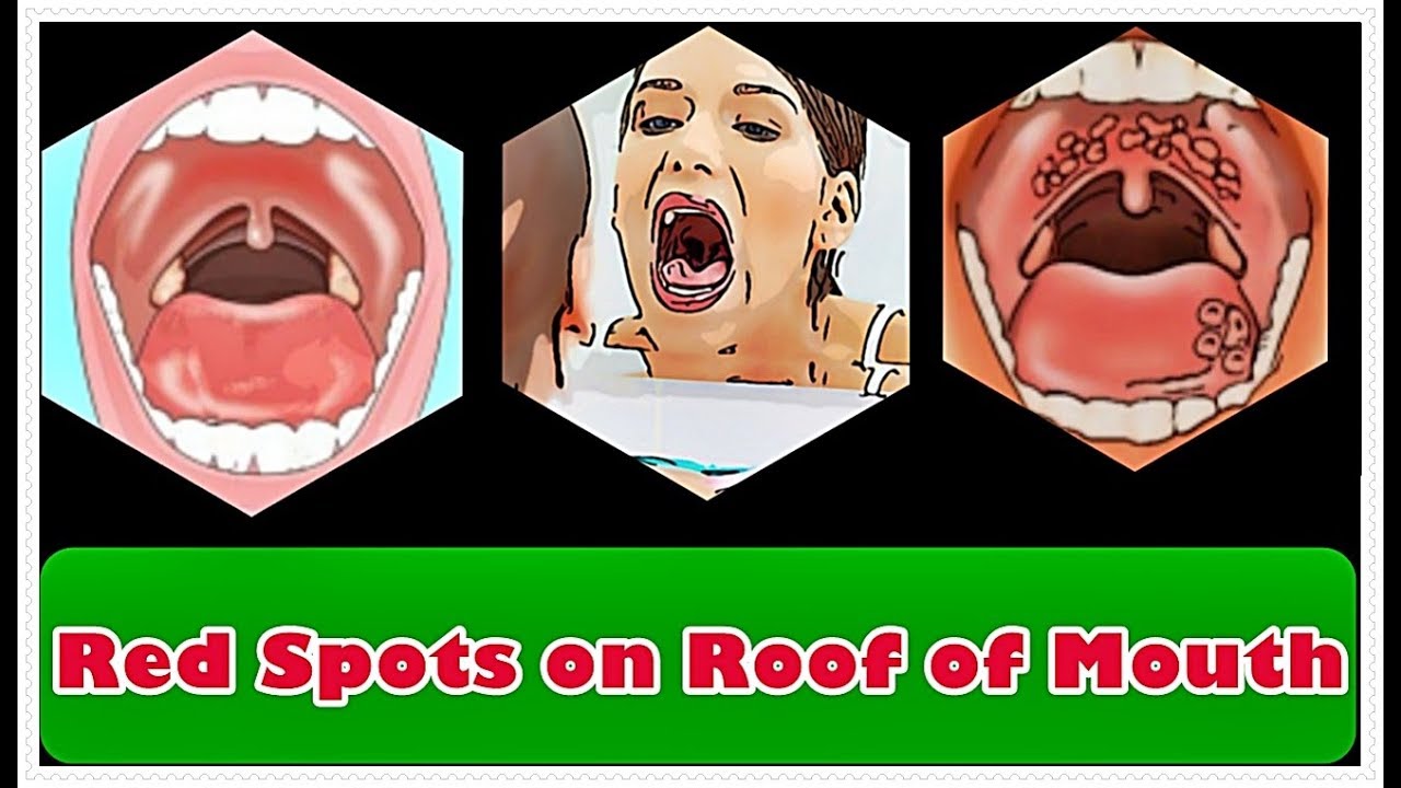 Red Spots on Roof of Mouth