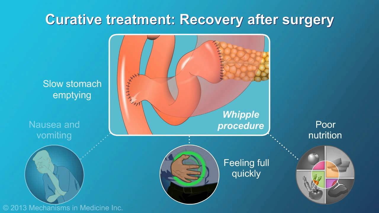 Pancreatic Cancer: Treatment and Outcomes