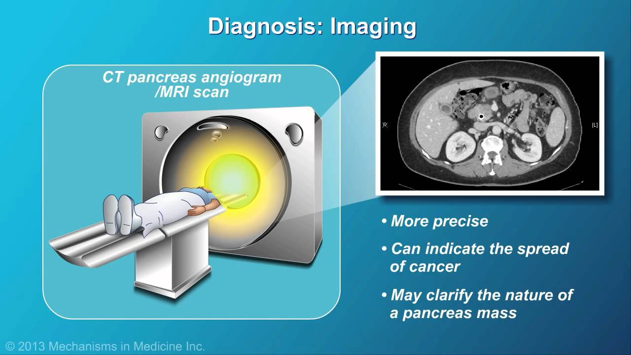 Pancreatic Cancer: Pathophysiology, Diagnosis and Staging
