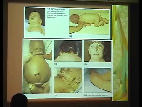 Dysmorphology Syndromes In The Neonate