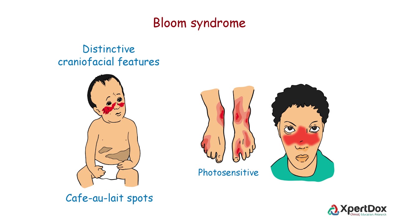 Bloom Syndrome