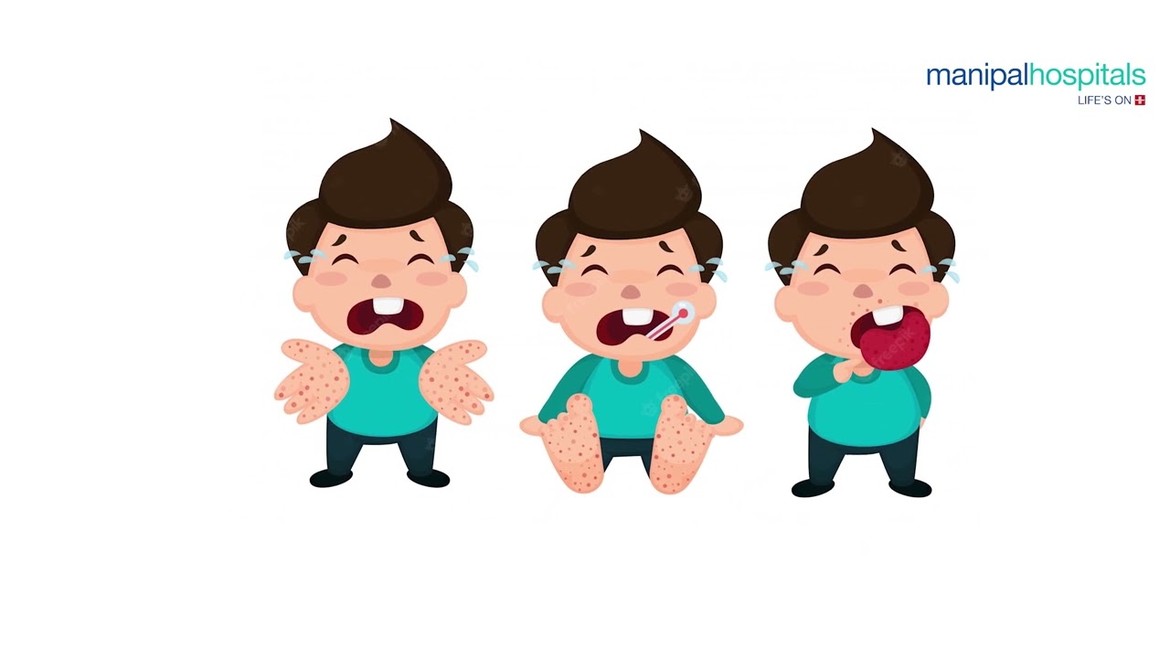 Contagious viral infection in children | Dr. Sumit Gupta | Manipal Hospital , Ghaziabad
