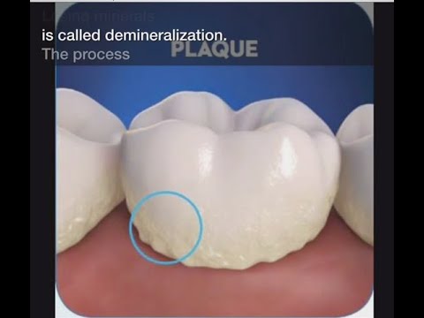 Stage 1 of Tooth Decay: Demineralization