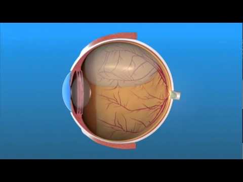 Pneumatic Retinopexy