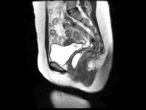 Gartner duct cyst