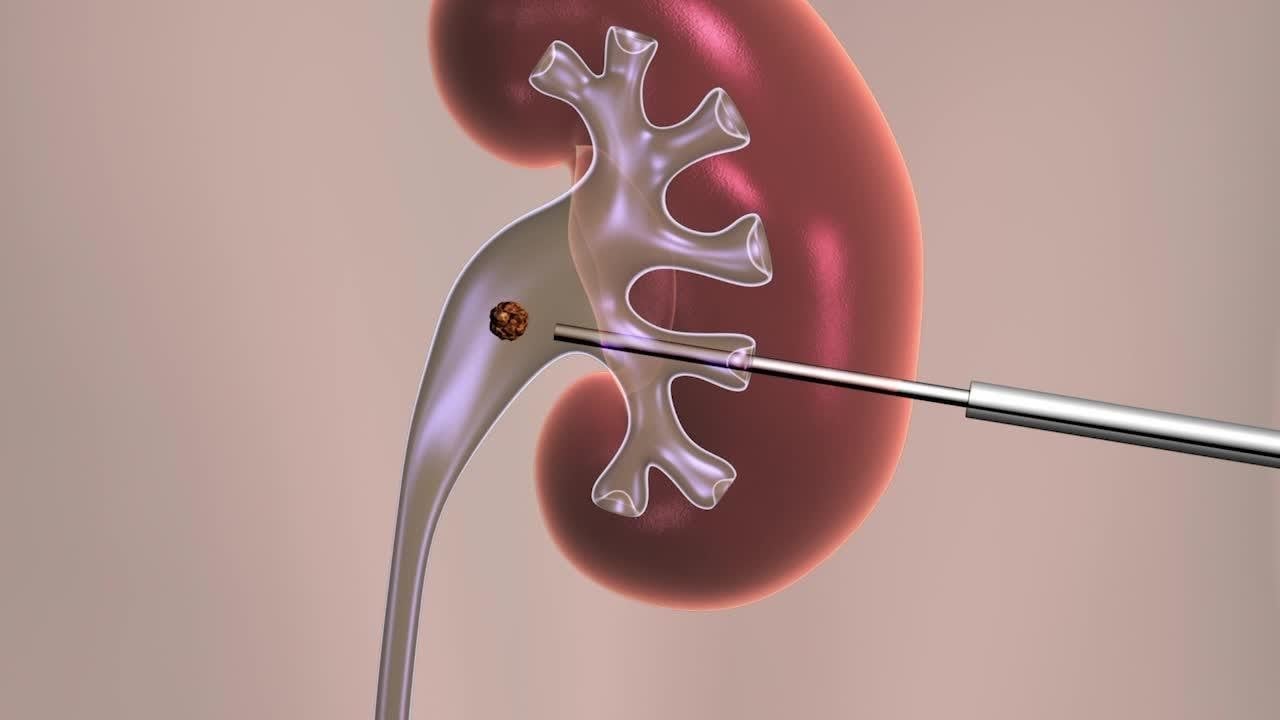 Percutaneous Nephrolithotomy