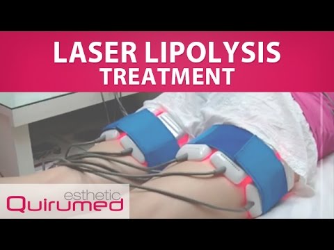 Laser Lipolysis Treatment (734-BL009)