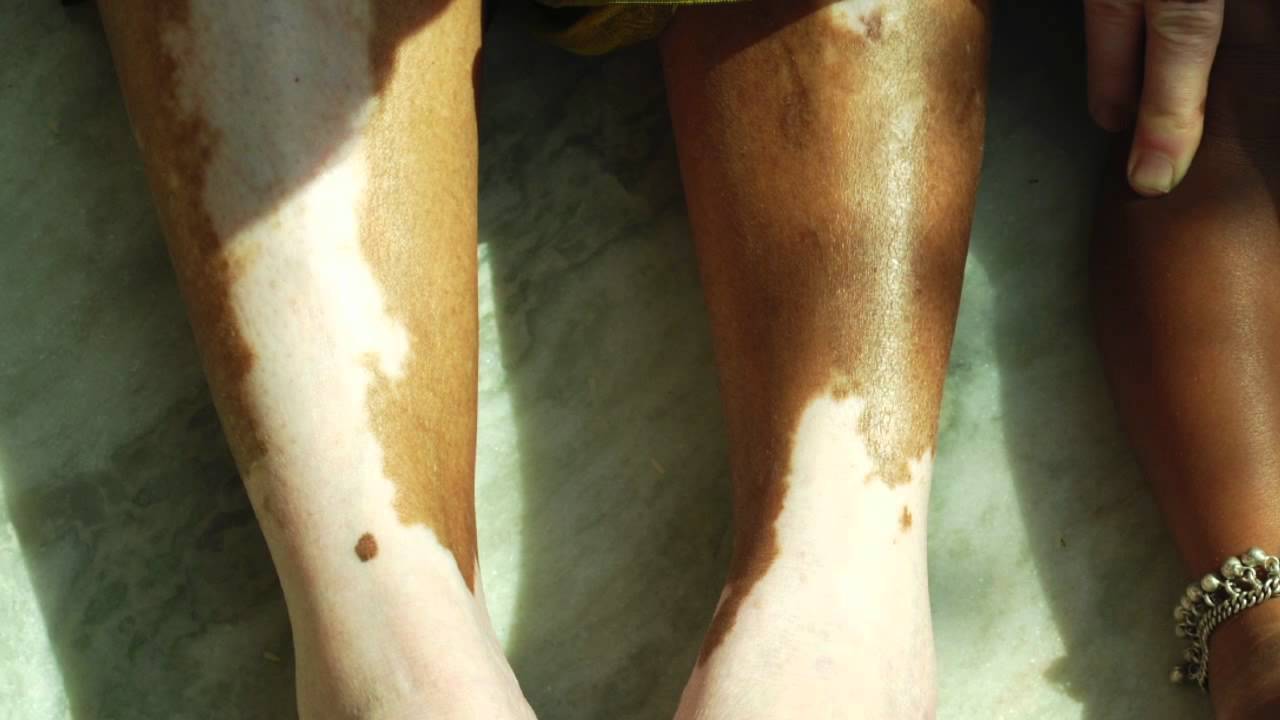What is Vitiligo?
