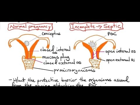Septic miscarriage