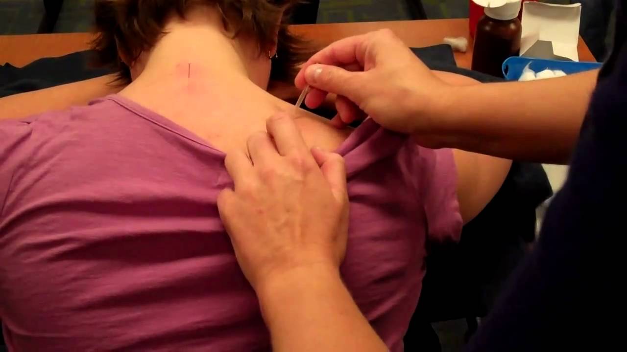 McMaster Medical Acupuncture Program: Acupuncture Point GB 21