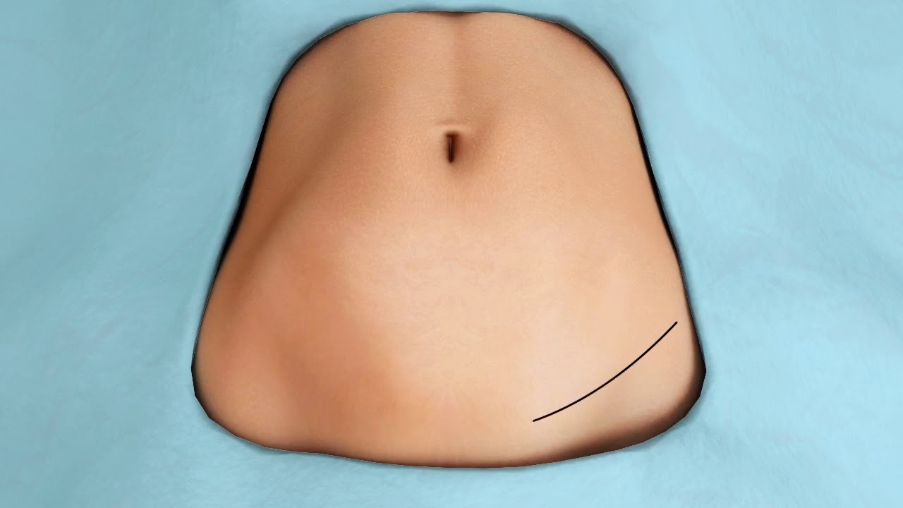 Tummy Tuck Animation