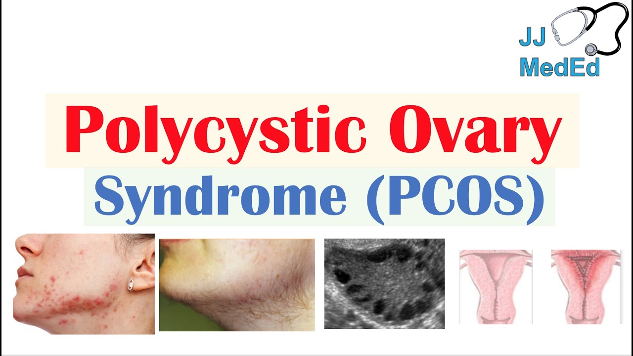 Polycystic Ovary Syndrome (PCOS) - Causes, Risks and Treatments