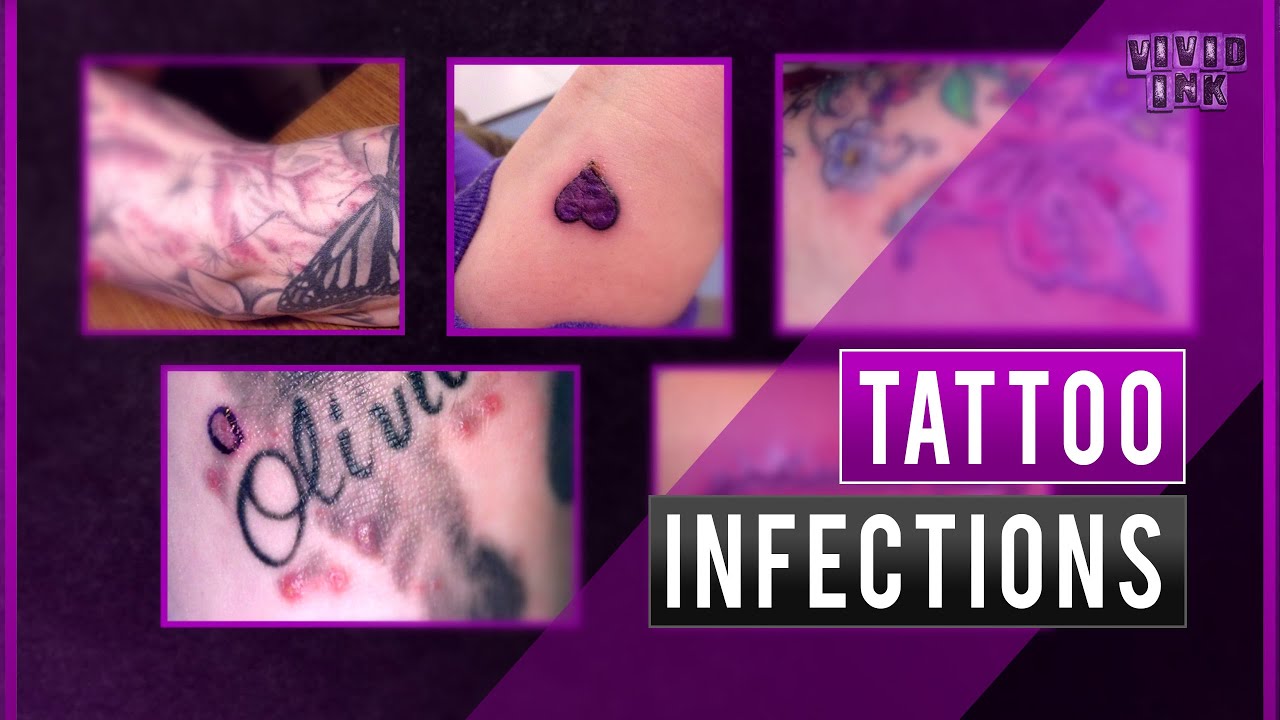 Everything you need to know about tattoo infections.