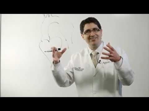 Aortic Aneurysm Types - Sacular & Fusiform Aortic Aneurysms