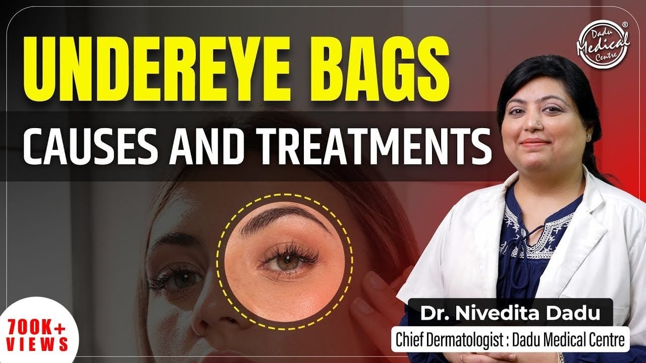 How to get rid of Under Eye Bags or Puffy Eyes? | Under Eye Bags से छुटकारा कैसे पाएं | DMC