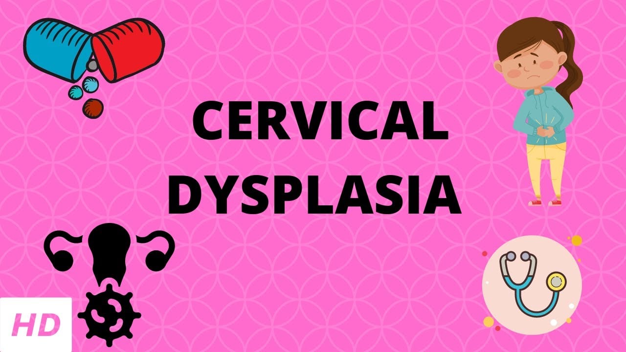 Cervical Dysplasia, Causes, Signs and Symptoms, Diagnosis and Treatment.