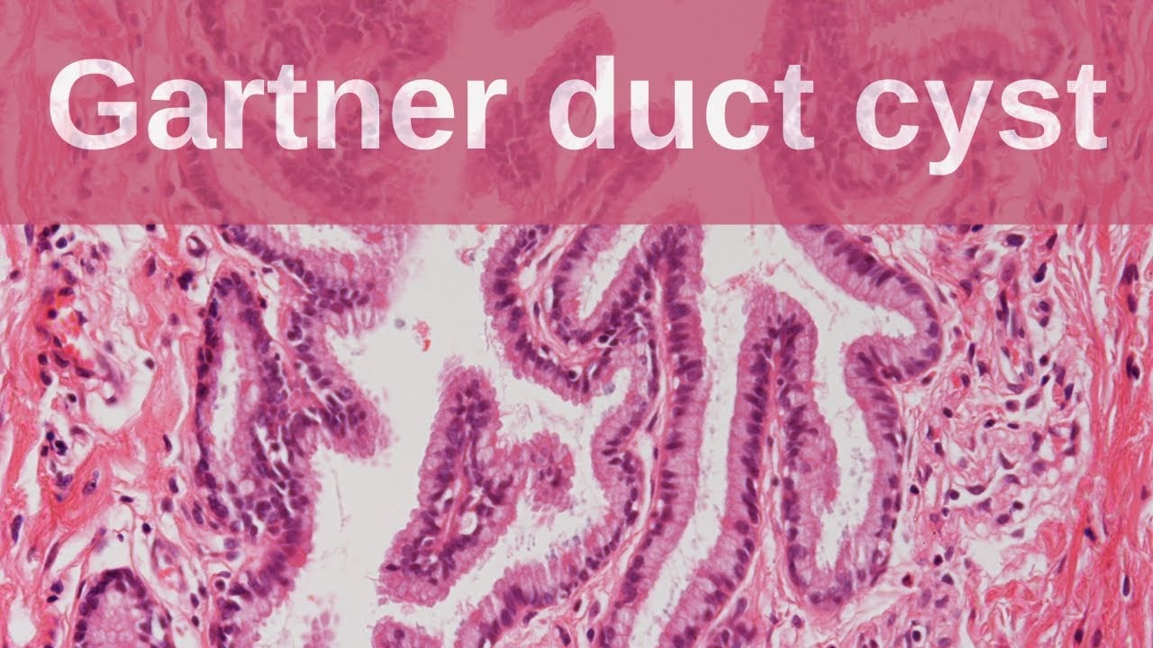 Gartner Duct Cyst - Pathology mini tutorial