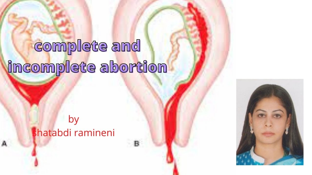 Complete and incomplete abortion