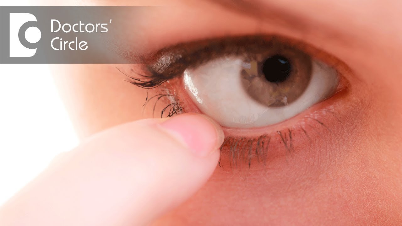 What are the symptoms of a Stye? - Dr. Sunita Rana Agarwal