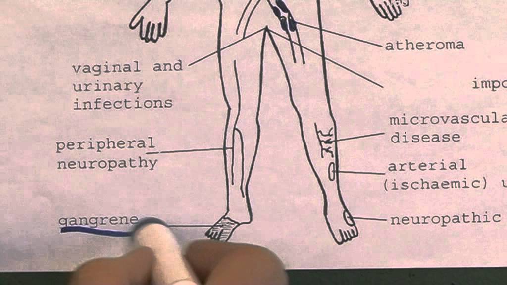 Long term complications of diabetes