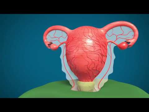 Dr. Panicker's Caesarean Hysterectomy - Animation