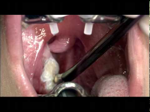 Tonsil Cryptolysis to Address Tonsil Stones