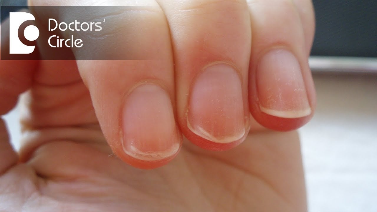 What can cause peeling of nails in an individual? - Dr. Aruna Prasad