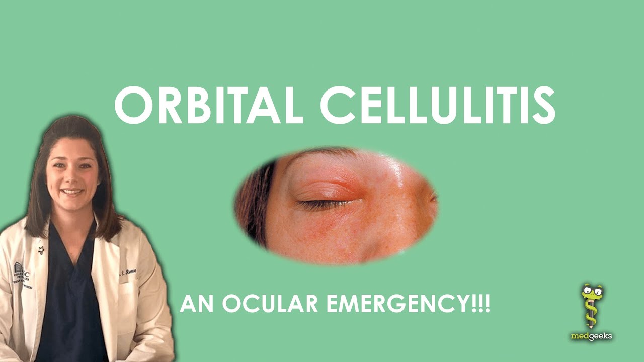 Orbital Cellulitis an ocular emergency!