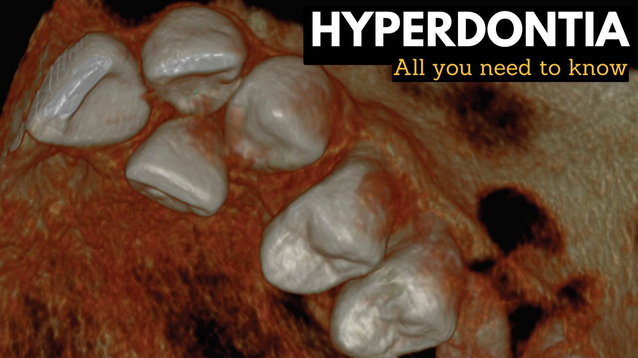 Hyperdontia, Causes, Signs and Symptoms, Diagnosis and Treatment.