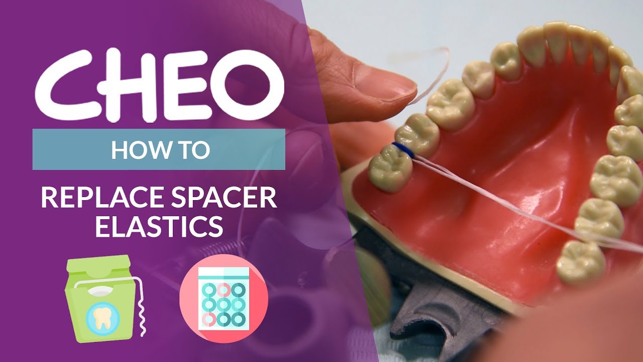 How to install spacer elastics
