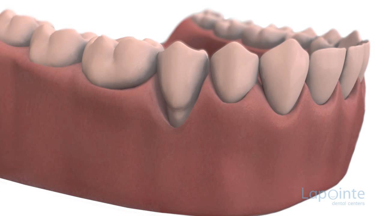 Soft tissues grafting - Lapointe dental centres