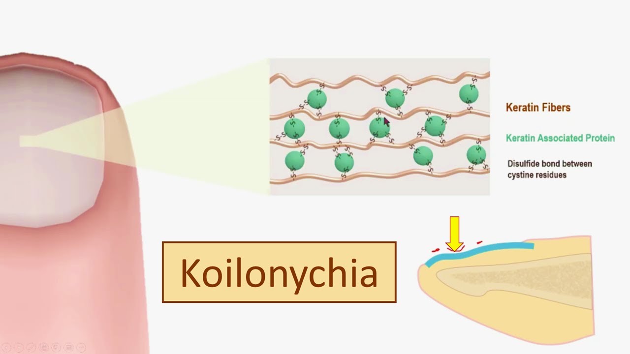 How Koilonychia develops in Iron Deficiency Anemia -  Koilonychia (spoon nails) pathogenesis