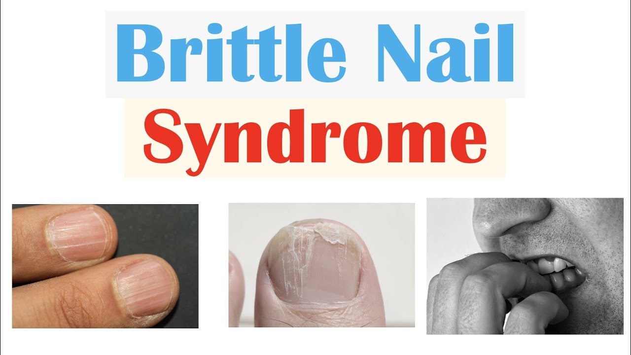 Brittle Nail Syndrome | Causes, Signs & Symptoms, Diagnosis, Treatment, Supplements