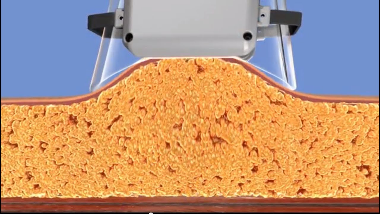 How Coolsculpting Works