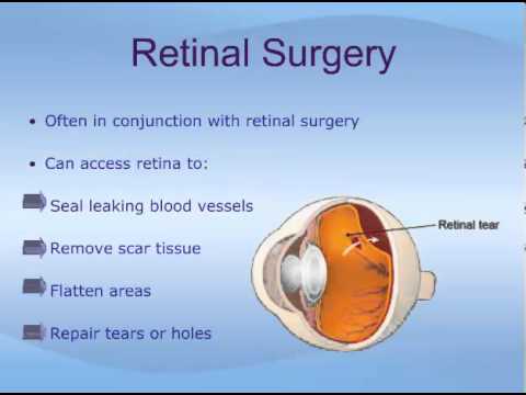 Vitrectomy