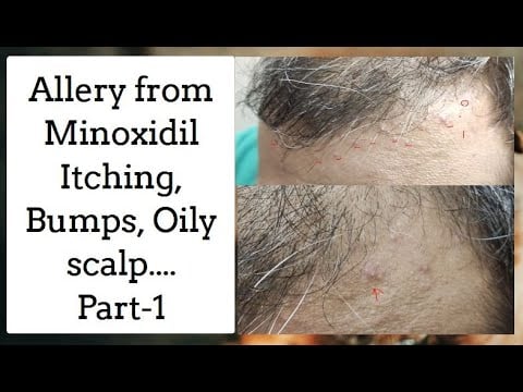 Allergy from Minoxidil | Itching due to minoxidil | Minoxidil side effects | KV Hair Care