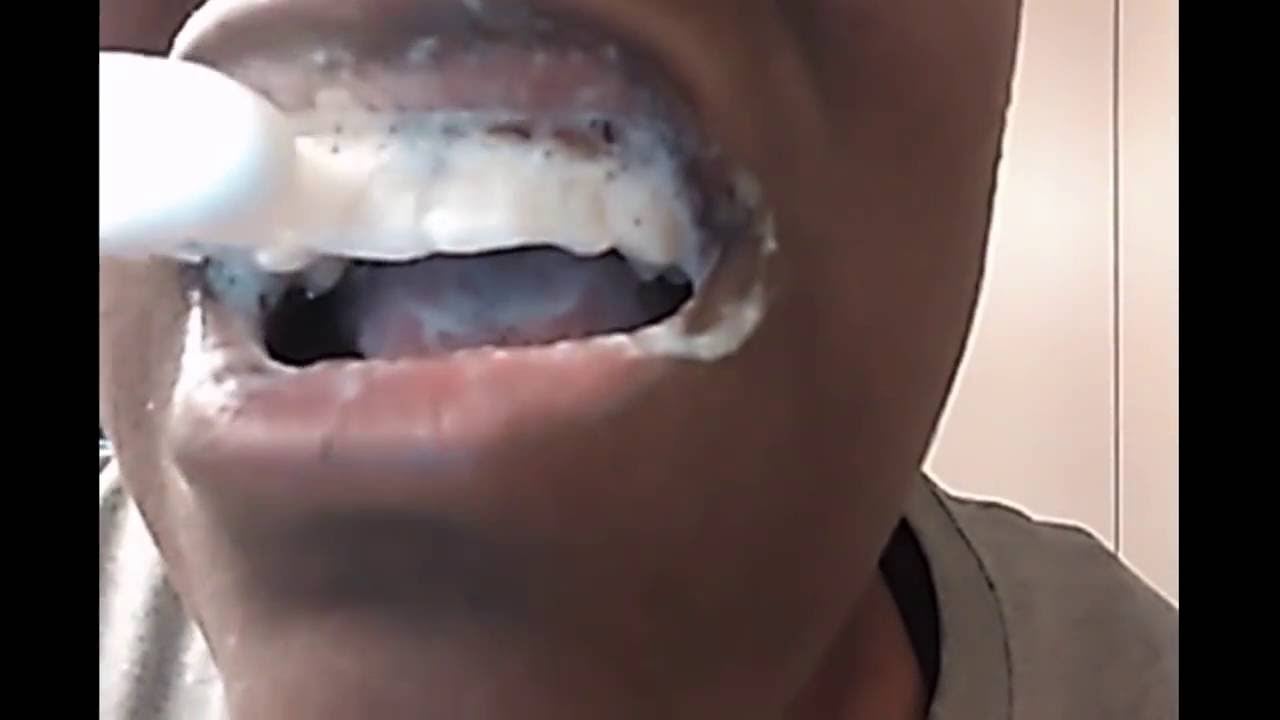 [WARNING] Teeth Whitening Baking Soda and Lemon - Bad Reaction - Before & After | The Mouth Episode