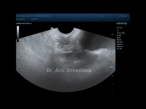 GARTNER'S DUCT CYST