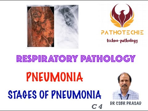 Pneumonia - Stages of pneumonia