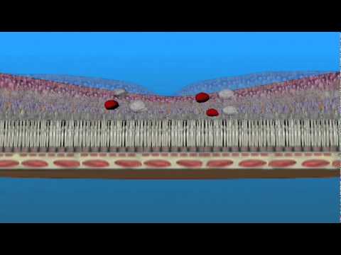Macular Edema and Ischemia