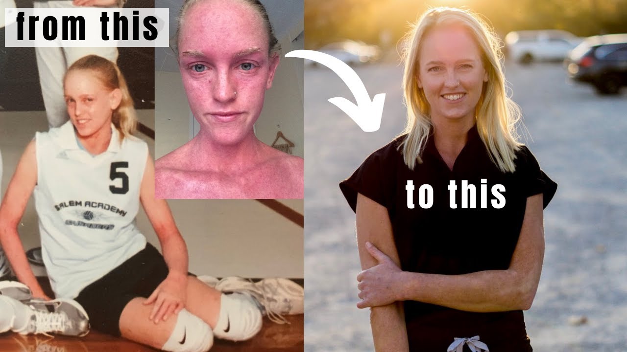 How I Healed My Eczema Naturally | Tips for Eczema #shorts
