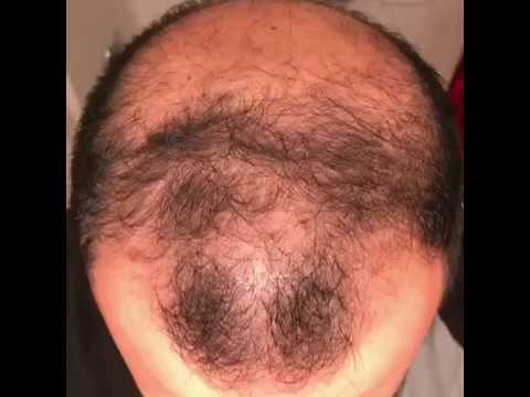 6 months using minoxidil - Rogaine 5% Before & After results