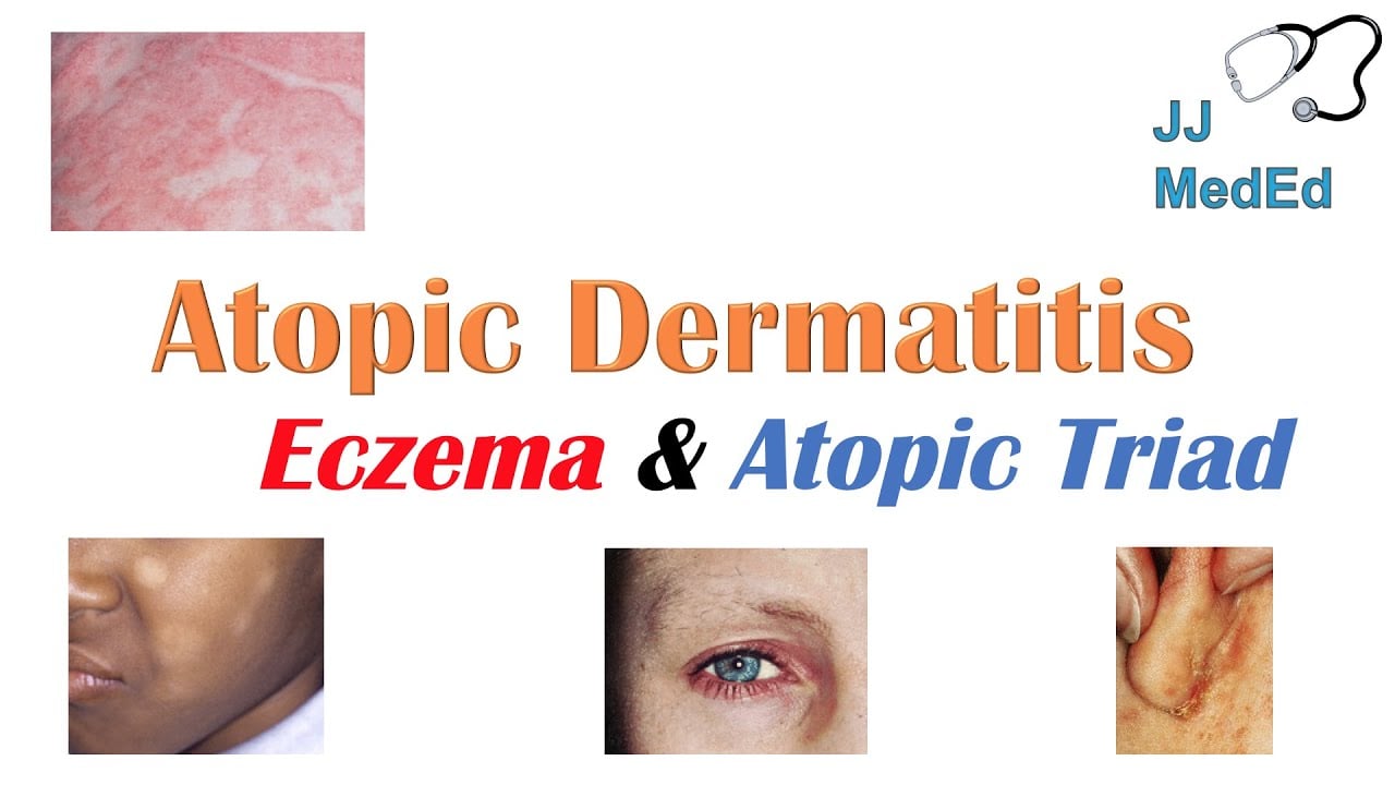 Eczema (Atopic Dermatitis) | Atopic Triad, Triggers, Who gets it, Why does it happen, & Treatment