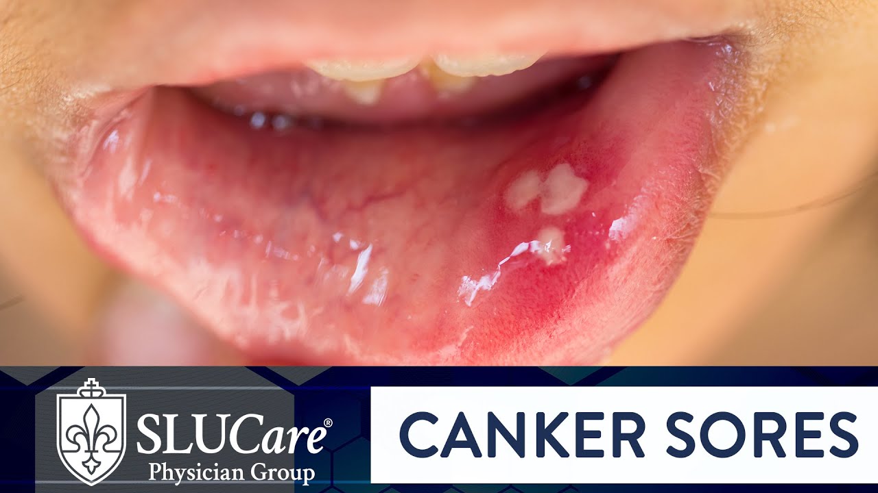 Determining Causes & Treatment for Canker Sores - SLUCare Otolaryngology