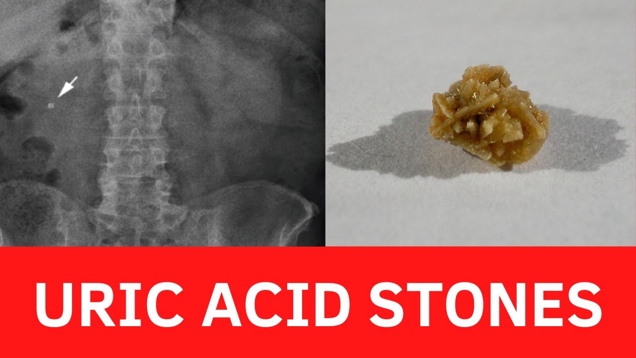 URIC ACID STONES- How to avoid?: Causes- Symptoms-Treatment
