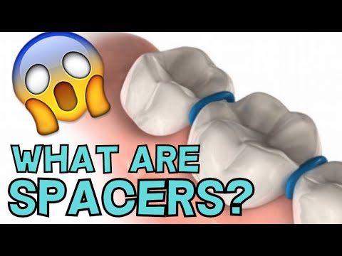 ORTHODONTIC SPACERS: WHAT ARE THEY AND WHY DO YOU NEED THEM?