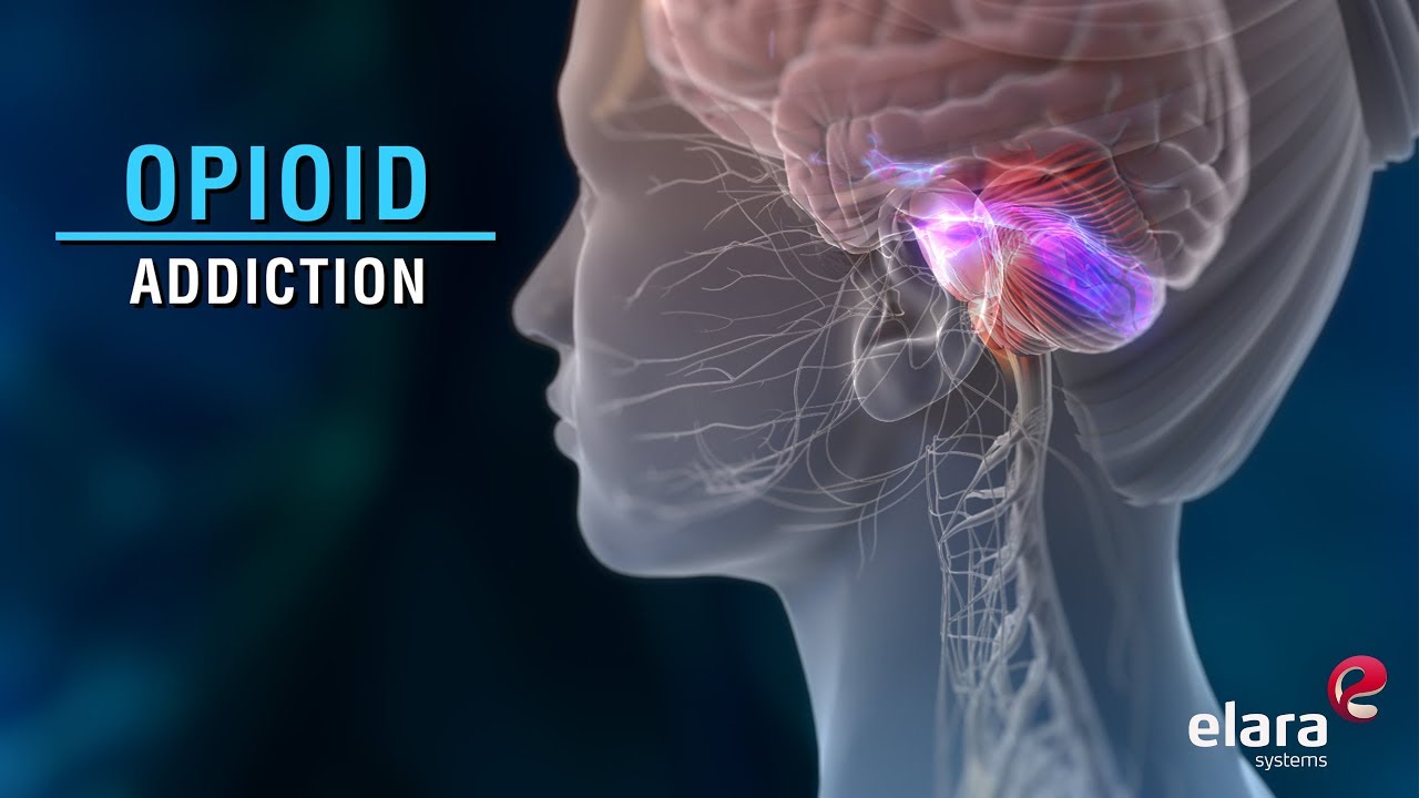 What is Opioid Addiction? Animation Video Answers the Question.